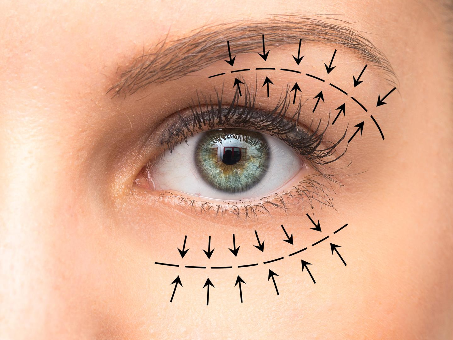 Blefaroplastia